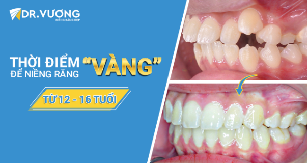 Độ tuổi lý tưởng để niềng răng? - Ảnh 3.