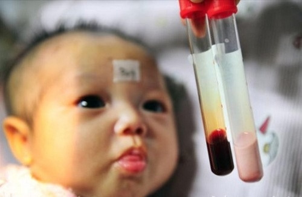 Thalassemia - căn bệnh khiến trẻ thiếu máu nhưng thừa sắt bẩm sinh - Ảnh 1.