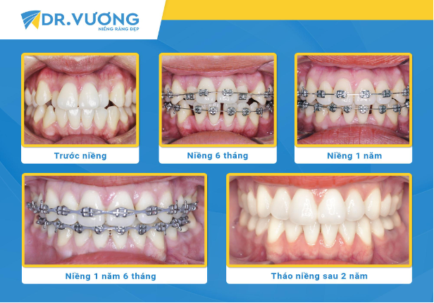 Nha khoa Dr. Vương chia sẻ 4 sự thật về niềng răng - Ảnh 4.