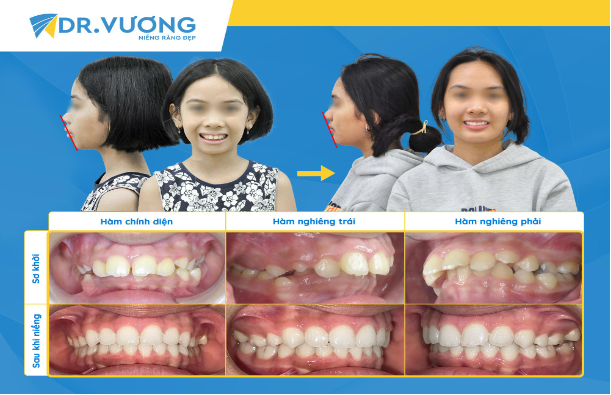 Nha khoa Dr. Vương chia sẻ 4 sự thật về niềng răng - Ảnh 5.