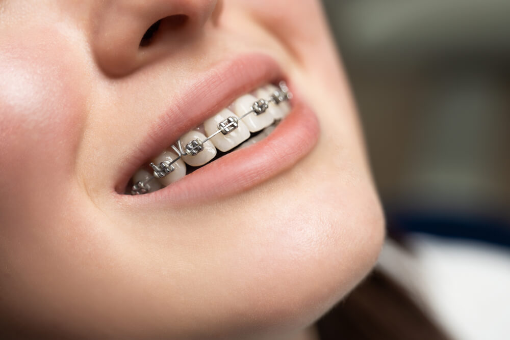 types-of-braces1648491073-1678439198493212345072-1678503062871-167850306296718011331.jpg