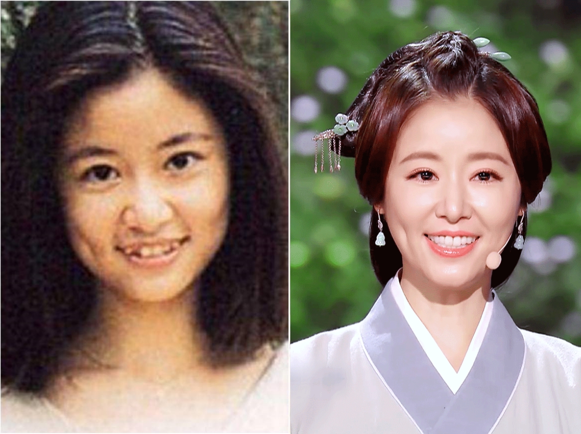 Song Hye Kyo, Lâm Tâm Như... thăng hạng nhan sắc nhờ niềng răng - Ảnh 2.