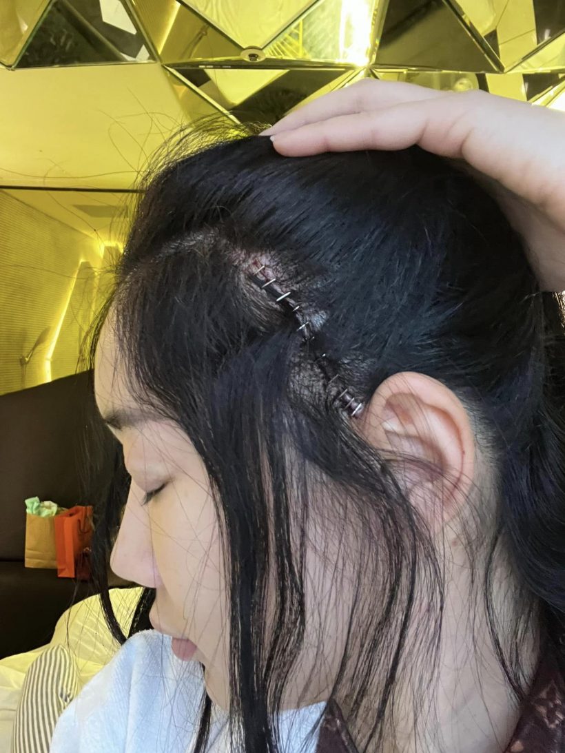 Hoa hậu Thái Lan đăng ảnh sẹo dài ở đầu sau phẫu thuật thẩm mỹ - Ảnh 3.