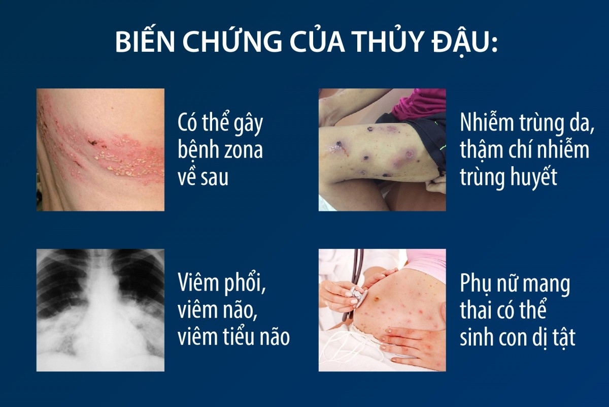 Bệnh thủy đậu bùng phát ở Hà Nội: Chuyên gia khuyến cáo cách phòng bệnh - Ảnh 1.
