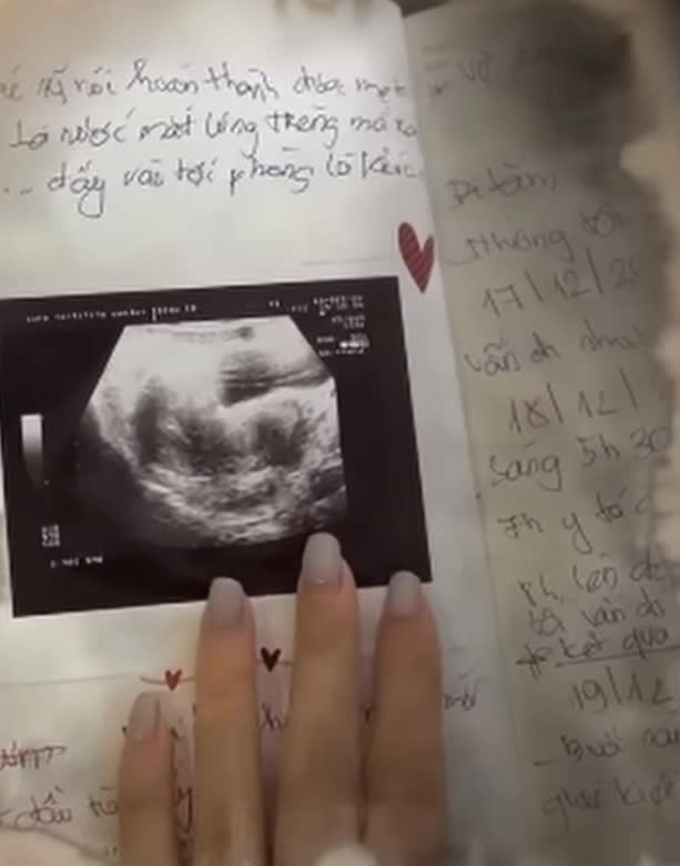 มินห์ ฮัง ให้ข้อมูลเกี่ยวกับการตั้งครรภ์แฝด: มีเพียงตัวอ่อนเดียวเท่านั้นที่รอดชีวิต หยุดทำทันทีเพราะมันเจ็บปวดเกินไป - รูปภาพที่ 4