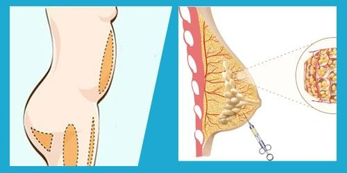 2 kiểu nâng ngực bị giới chuyên gia ghét bỏ, chị em đi làm đẹp cần tránh kẻo hối không kịp - Ảnh 2.