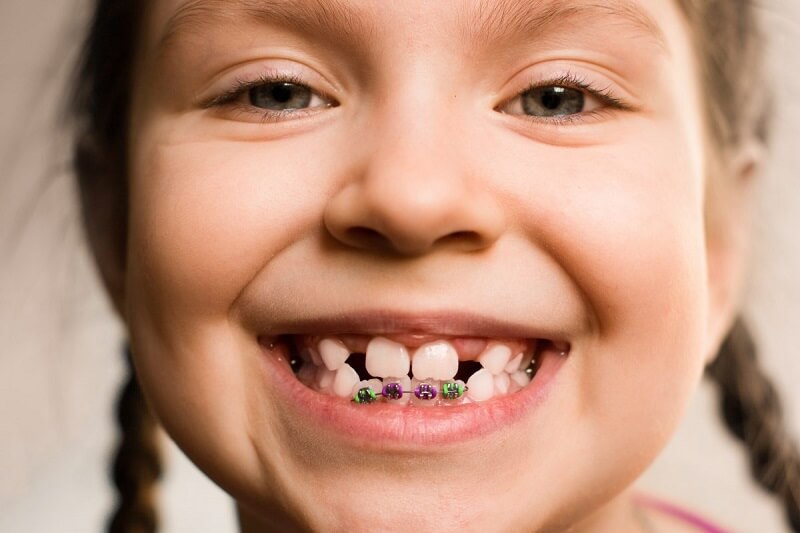 Bác sĩ răng hàm mặt chia sẻ: Điều bố mẹ cần làm trước khi cho con đi chỉnh nha, cần nhớ thời điểm vàng nên thực hiện - Ảnh 3.