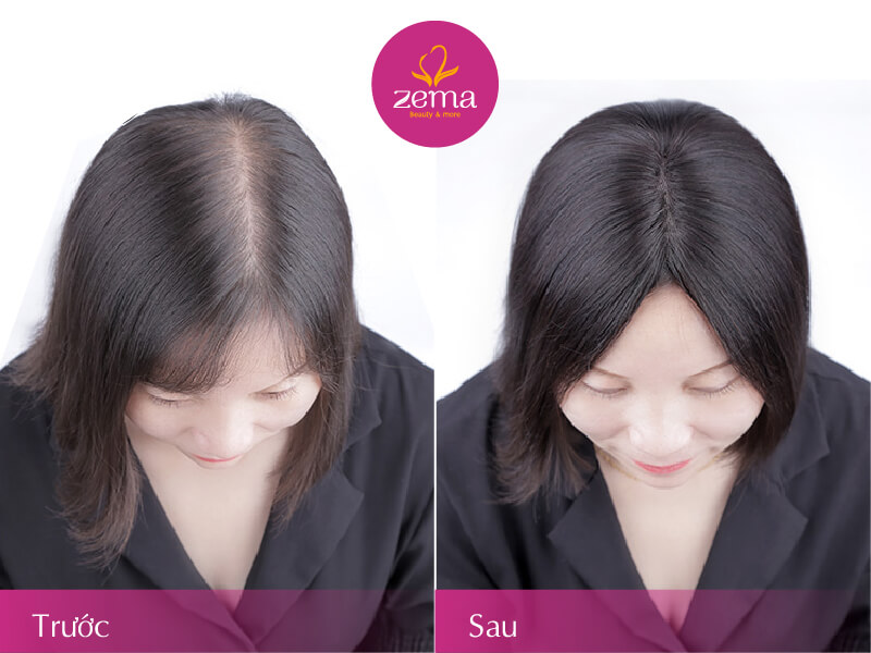 7 cách trị rụng tóc hiệu quả, giúp tóc dày mượt bồng bềnh - Ảnh 4.