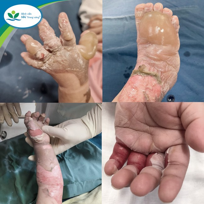 B&aacute;c sĩ hướng dẫn c&aacute;ch sơ cứu đ&uacute;ng khi trẻ bị bỏng - Ảnh 2.