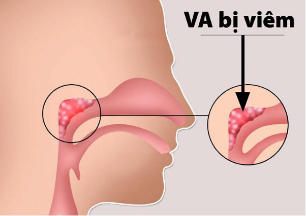 Viêm VA ở trẻ: Cẩn trọng để tránh biến chứng ngưng thở khi ngủ - Ảnh 1.