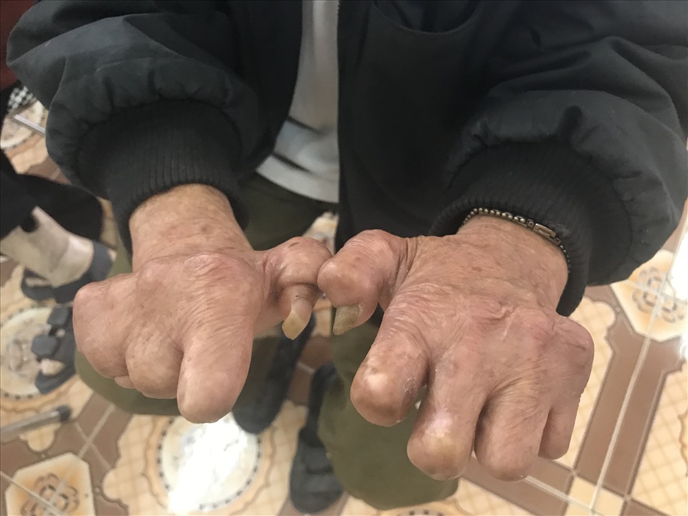 Phát hiện ca bệnh phong mới là người phụ nữ 39 tuổi - Ảnh 2. Phát hiện ca bệnh phong mới là người phụ nữ 39 tuổi - Ảnh 2.