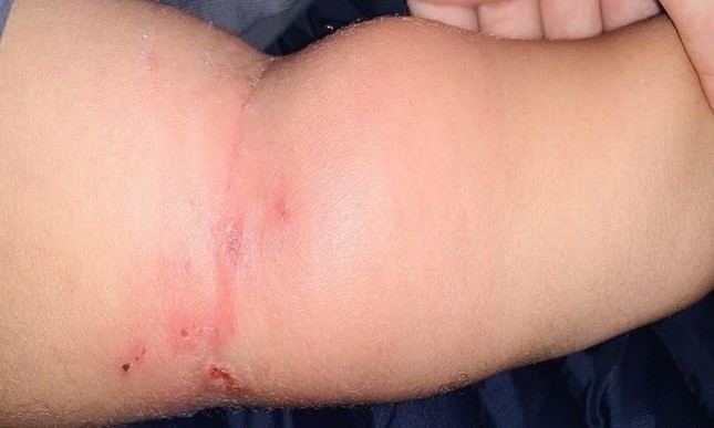 Bé 2 tuổi nhiễm trùng máu từ vết muỗi đốt - Ảnh 1.