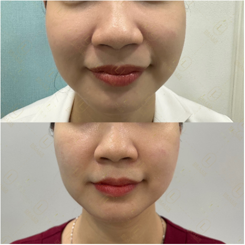 B&aacute;c sĩ T&ocirc; Lan Phương chia sẻ về c&ocirc;ng nghệ n&acirc;ng cơ mới Sofwave  - Ảnh 4.