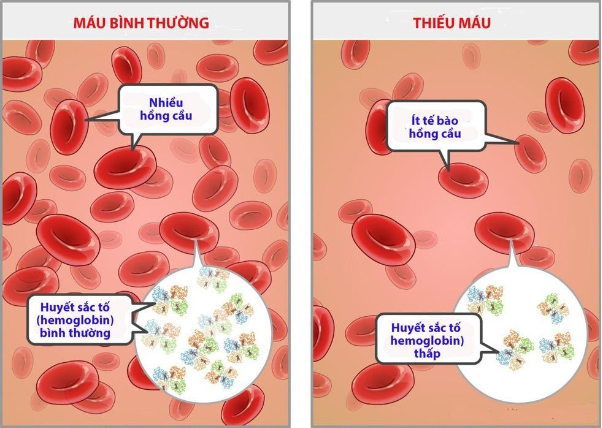 Tại sao trẻ thiếu m&aacute;u dinh dưỡng ngo&agrave;i bổ sung sắt lại cần th&ecirc;m kẽm? - Ảnh 3.