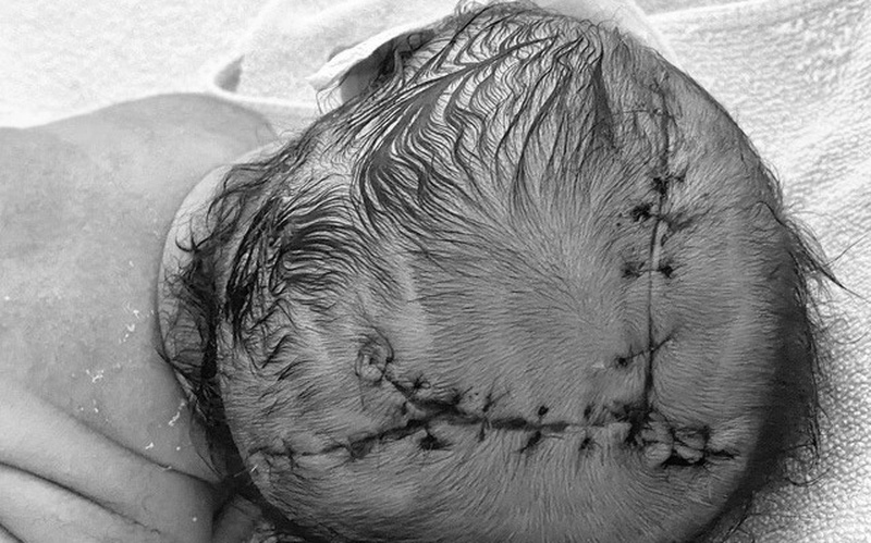 Khâu 21 mũi cho trẻ sơ sinh bị lóc da đầu sau khi sinh tại nhà - Ảnh 1.