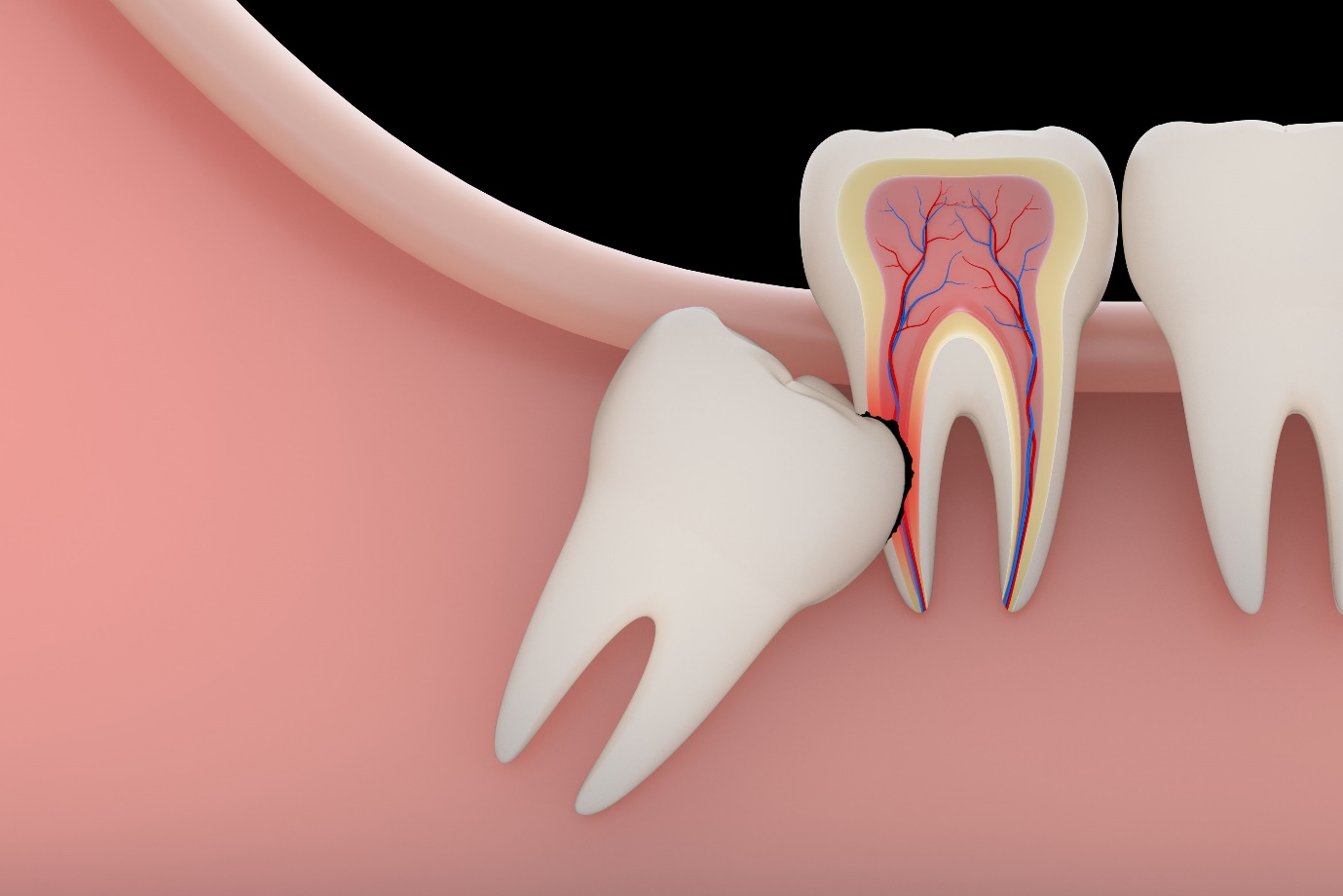 Cô gái 23 tuổi tử vong sau nhổ răng khôn: Bác sĩ chỉ ra những lưu ý sống còn - Ảnh 2.