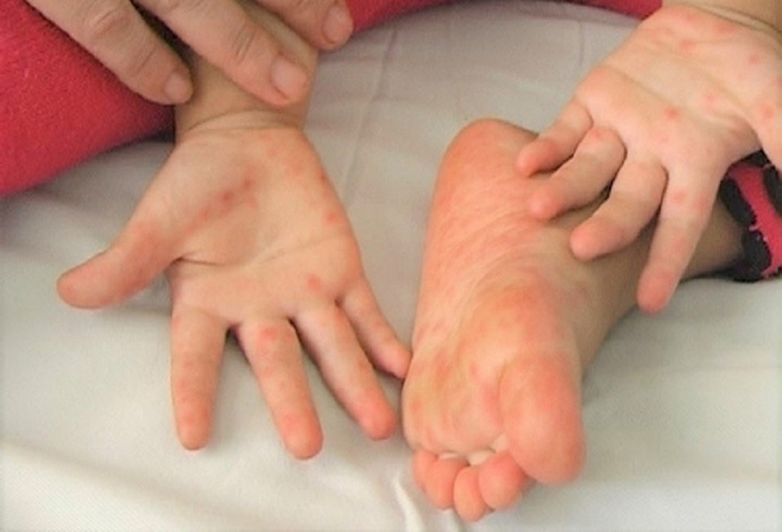 Bé trai 1 tuổi ở Đắk Lắk tử vong vì bệnh tay chân miệng - Ảnh 1.