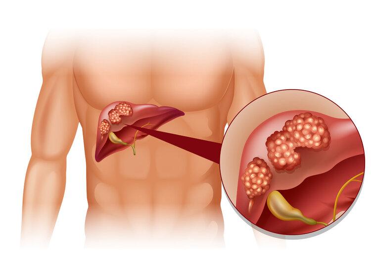 3 loại &quot;ung thư vợ chồng&quot; dễ phát triển – Chỉ cần 1 người trong nhà mắc thì người kia phải đi khám tức thì - Ảnh 3.