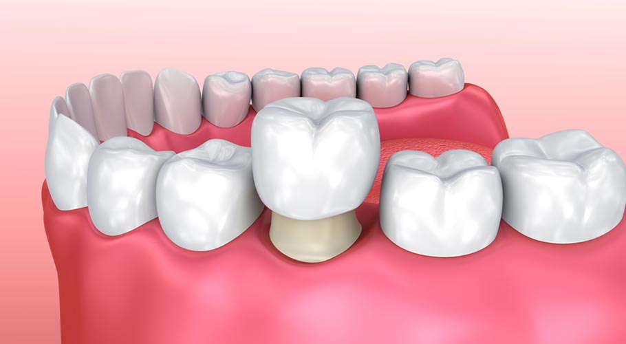 Một kiểu thẩm mỹ răng rất dễ gây hôi miệng, bác sĩ chỉ ra giải pháp ngăn chặn - Ảnh 3.