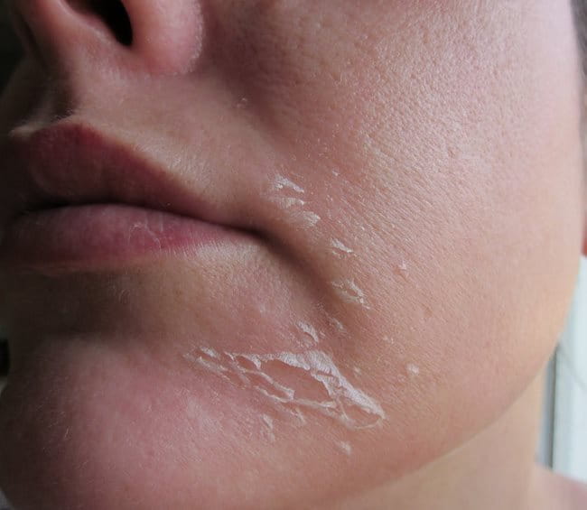 Peel da mùa hè để tăng sinh collagen: Chuyên gia khuyến cáo những lưu ý quan trọng - Ảnh 1.