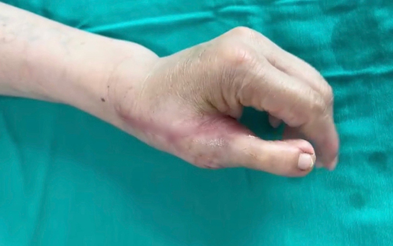 Tạo hình ngón tay cái từ ngón chân cho bệnh nhân bị tai nạn lao động - Ảnh 1.