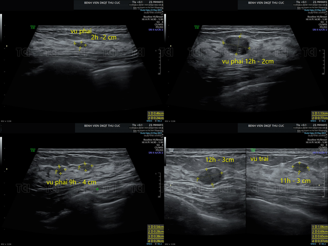Xử lý nhiều u xơ tuyến vú cho bệnh nhân 42 tuổi chỉ bằng 1 mũi kim - Ảnh 1.