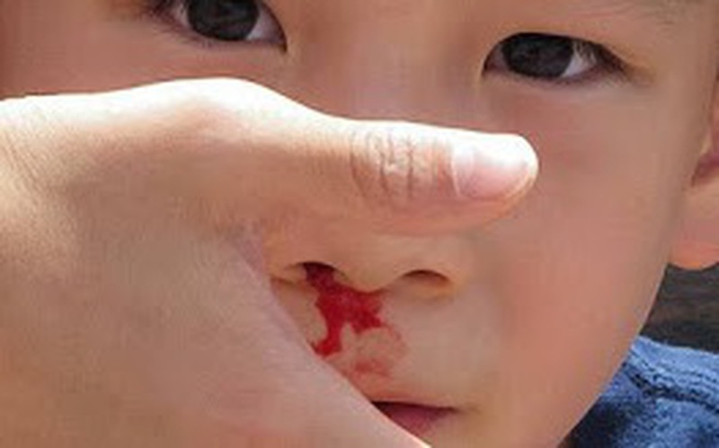 5 bước xử trí khi trẻ bị chảy máu cam - Ảnh 1.
