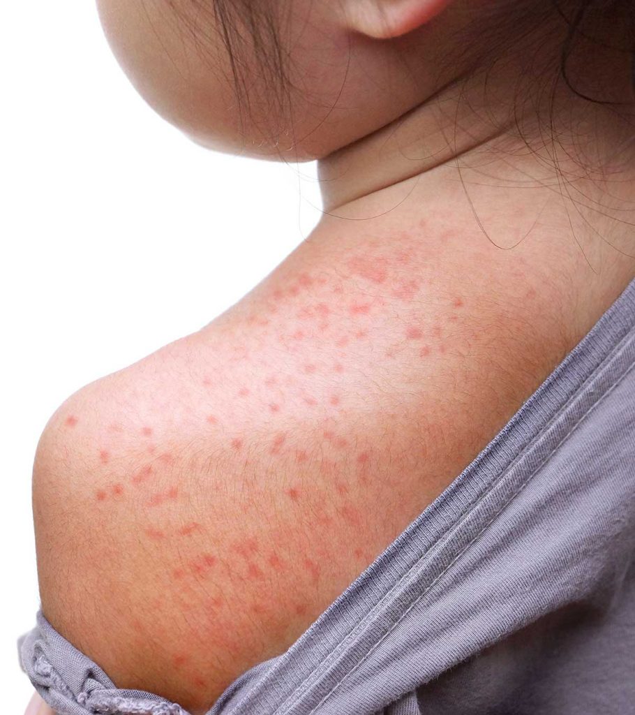 10 tình trạng gây phát ban và sẩn ngứa da mùa hè ở trẻ - Ảnh 1.