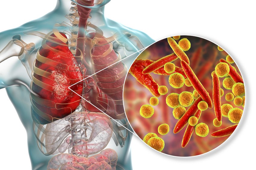 Bác sĩ cảnh báo các dấu hiệu nghi ngờ viêm phổi do vi khuẩn Mycoplasma - Ảnh 1.