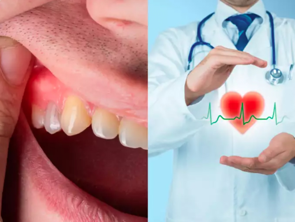 Bệnh nướu răng không được điều trị làm tăng nguy cơ mắc bệnh tim - Ảnh 1.