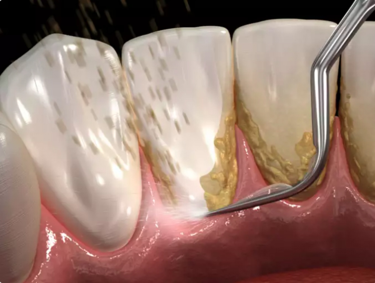 Bệnh nướu răng không được điều trị làm tăng nguy cơ mắc bệnh tim - Ảnh 4.
