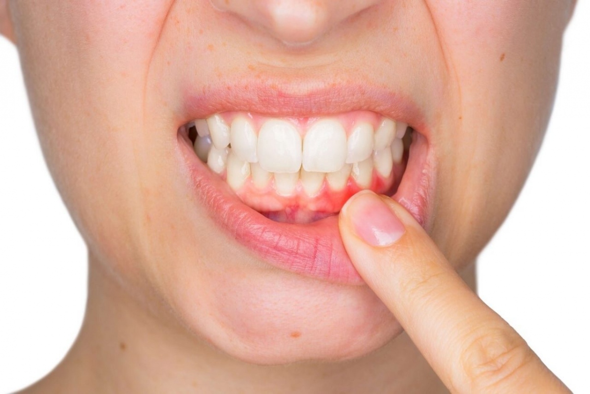 Bệnh nướu răng không được điều trị làm tăng nguy cơ mắc bệnh tim - Ảnh 2.