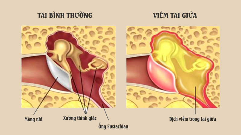 Bác sĩ kể trường hợp bé gái bị viêm tai giữa sau chuyến du lịch hè và lưu ý quan trọng cho phụ huynh  - Ảnh 3.