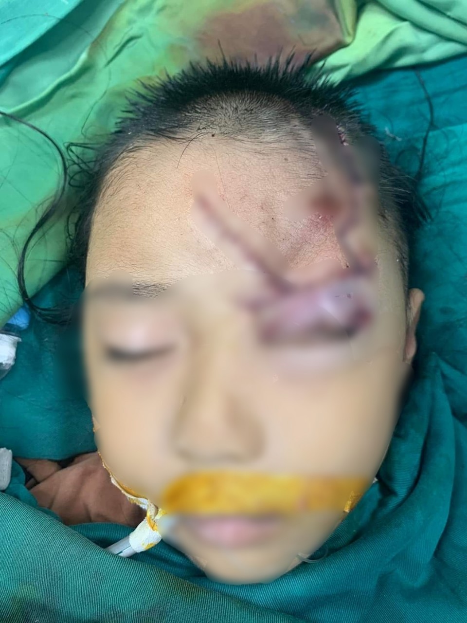 Bé trai 5 tuổi bị chó lạ cắn nát vùng mặt - Ảnh 1. Bé trai 5 tuổi bị chó lạ cắn nát vùng mặt - Ảnh 1.