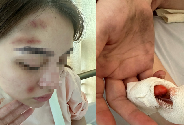 Một cảnh sát hình sự bị bạn gái tố hành hung gây thương tích - Ảnh 1. Một cảnh sát hình sự bị bạn gái tố hành hung gây thương tích - Ảnh 1.