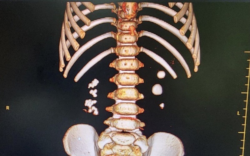 Bé trai 3 tuổi đi khám vì đau thắt lưng, đau mạn sườn, bác sĩ phát hiện bị sỏi thận 2 bên - Ảnh 1.