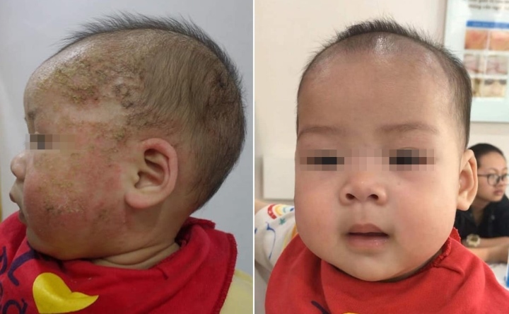 Bố mẹ dùng lá tắm điều trị con bị viêm da cơ địa, bé 8 tháng tuổi loét mặt - Ảnh 1.