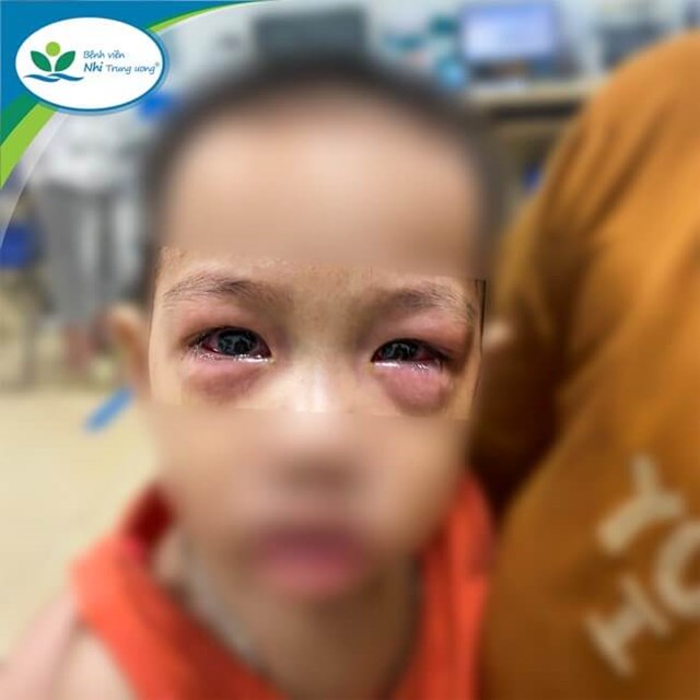 Hàng loạt trẻ đi khám vì đau mắt đỏ, cha mẹ lưu ý những gì? - Ảnh 1.