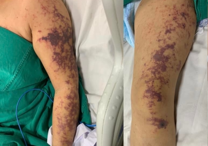 Suýt chết vì món ăn khoái khẩu của người Việt - Ảnh 1. Suýt chết vì món ăn khoái khẩu của người Việt - Ảnh 1.