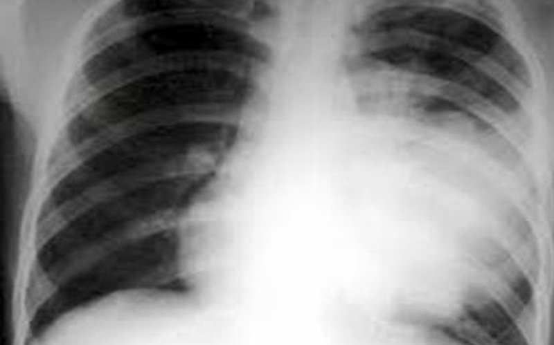Viêm phổi thùy ở trẻ em: Gia tăng ca bệnh, biến chứng khó lường - Ảnh 1.