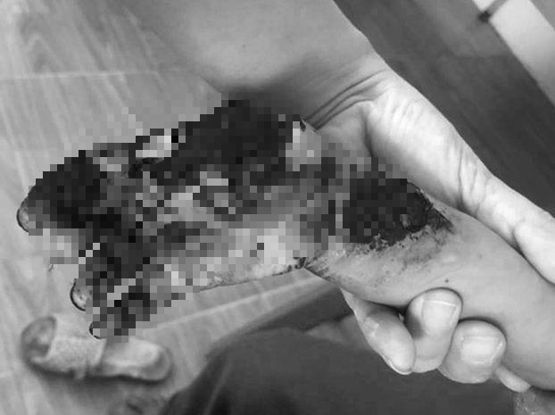 Cầm đầu dây sạc điện thoại, bé 3 tuổi bị giật cháy tay - Ảnh 1. Cầm đầu dây sạc điện thoại, bé 3 tuổi bị giật cháy tay - Ảnh 1.