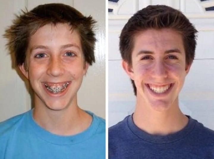 20 photos prove how braces change your smile - Photo 20.