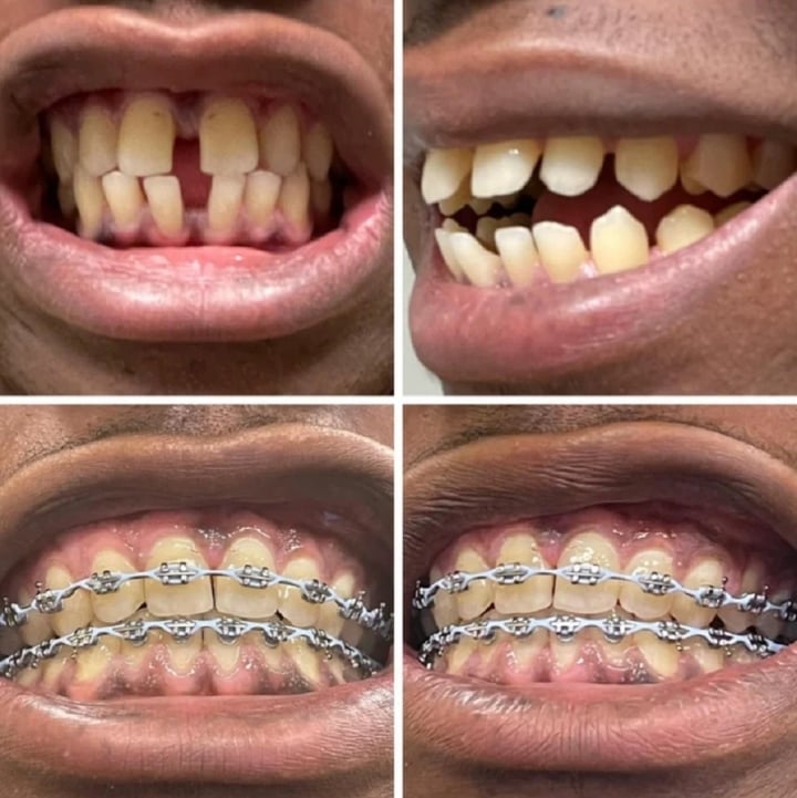 20 photos prove how braces change your smile - Photo 15.