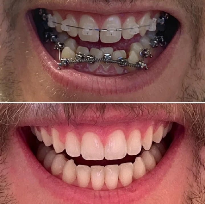 20 photos prove how braces change your smile - Photo 14.
