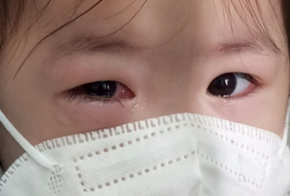 Đau mắt đỏ ở trẻ gia tăng, cảnh báo tình trạng dùng kháng sinh bừa bãi - Ảnh 2.