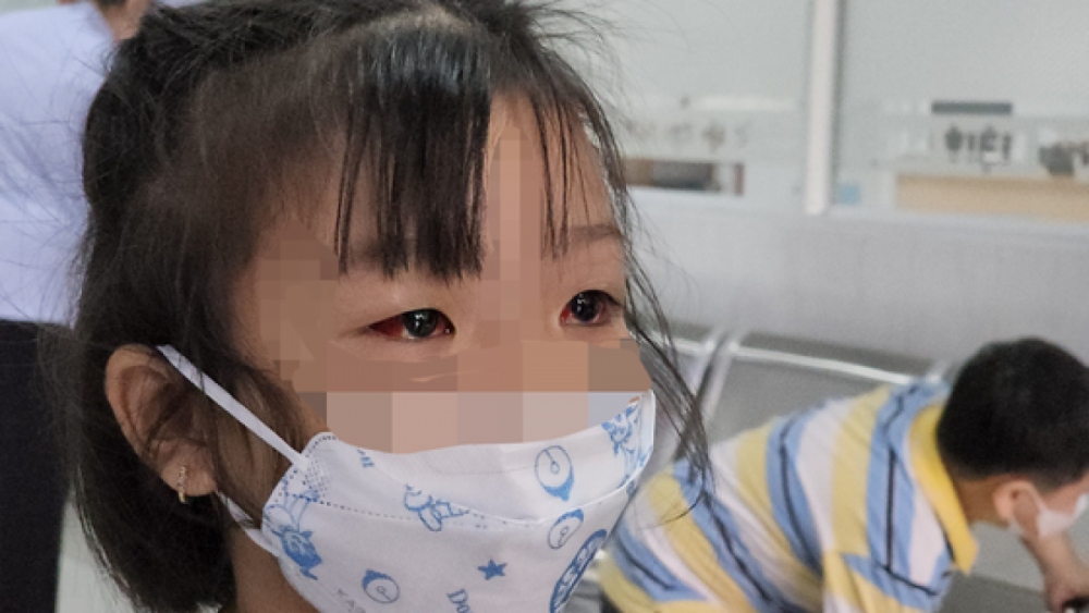 Đau mắt đỏ ở trẻ gia tăng, cảnh báo tình trạng dùng kháng sinh bừa bãi - Ảnh 1.
