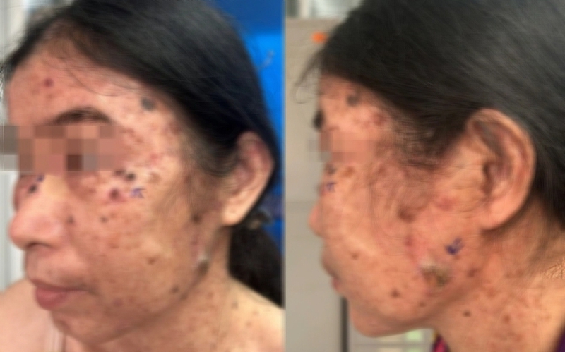 Ca bệnh hiếm gặp: Loạn sản thượng bì dạng hạt cơm tiến triển thành đa ung thư da - Ảnh 1. Ca bệnh hiếm gặp: Loạn sản thượng bì dạng hạt cơm tiến triển thành đa ung thư da - Ảnh 1.