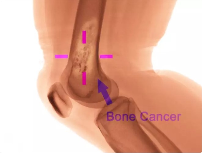 7 xét nghiệm để biết bạn có bị ung thư xương sarcoma không? - Ảnh 5.