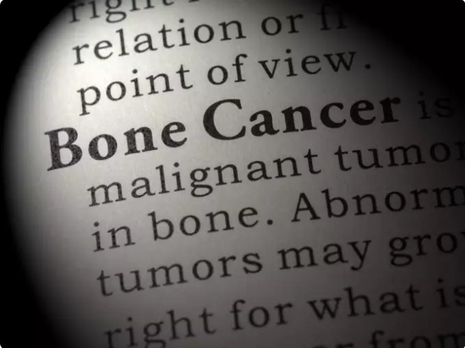 7 xét nghiệm để biết bạn có bị ung thư xương sarcoma không? - Ảnh 6.