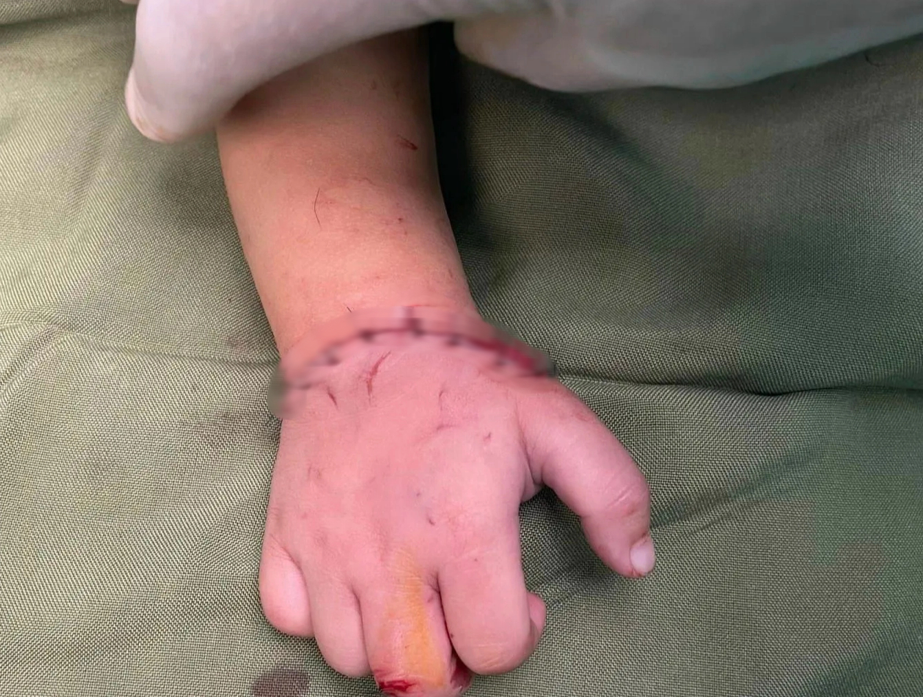 Bé gần 18 tháng tuổi bị máy cắt đá của gia đình cắt đứt lìa bàn tay - Ảnh 3.